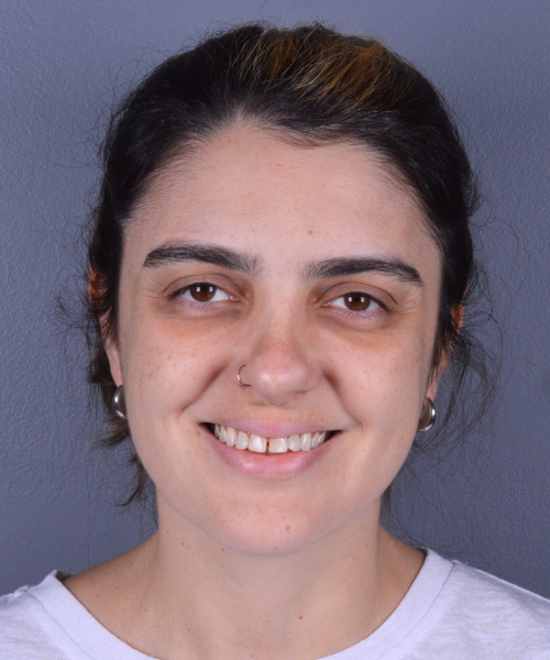 Paciente antes do tratamento, com dentes superiores desgastados
