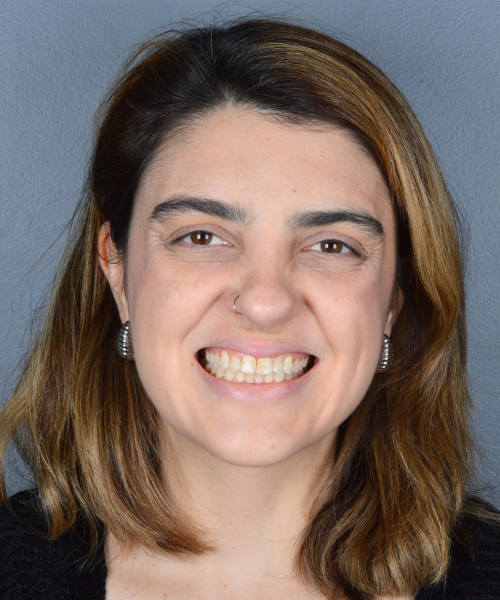 Mesma paciente depois do tratamento, com sorriso amplo e alinhado