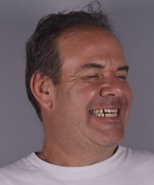 Paciente antes do tratamento, com dentes desalinhados e espaçados