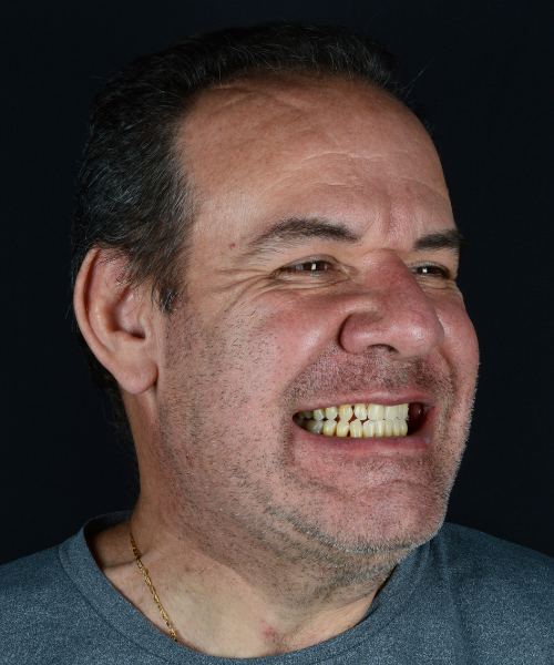 Mesmo paciente depois do tratamento, sorrindo com dentes alinhados