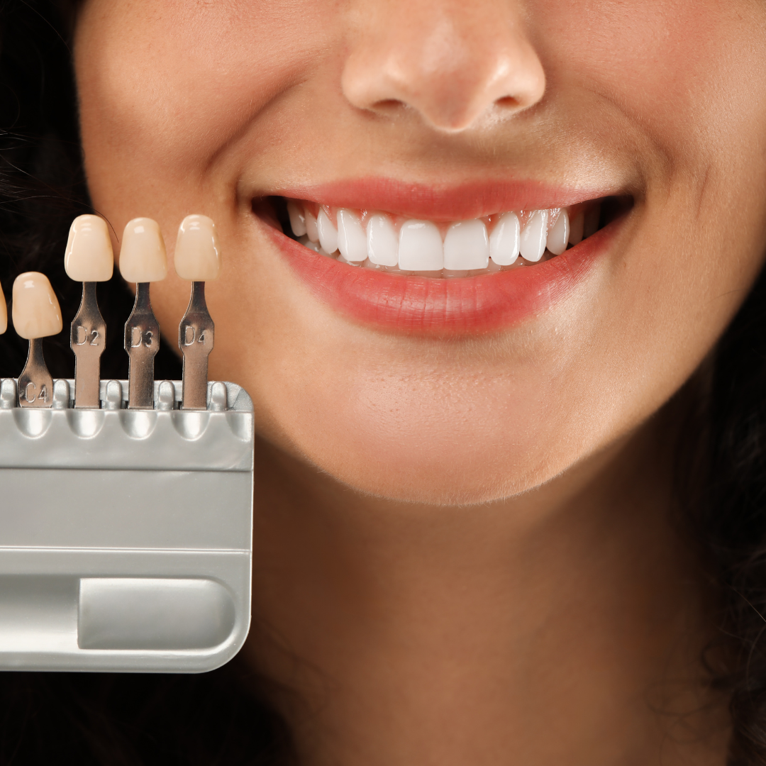 Close de um sorriso ao lado de uma escala de cores de dentes, usada para definir a cor ideal das facetas
