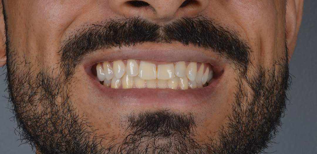 Antes do clareamento: dentes alinhados porém amarelados