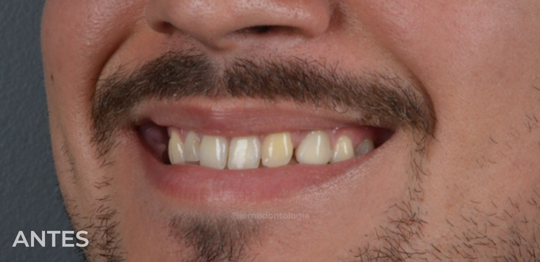 Antes das facetas: dentes superiores amarelados, desiguais e com pequenos espaços