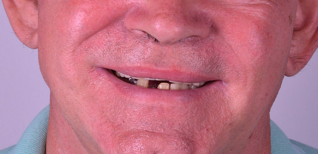 Antes: sorriso de paciente com perda e desgaste severo dos dentes