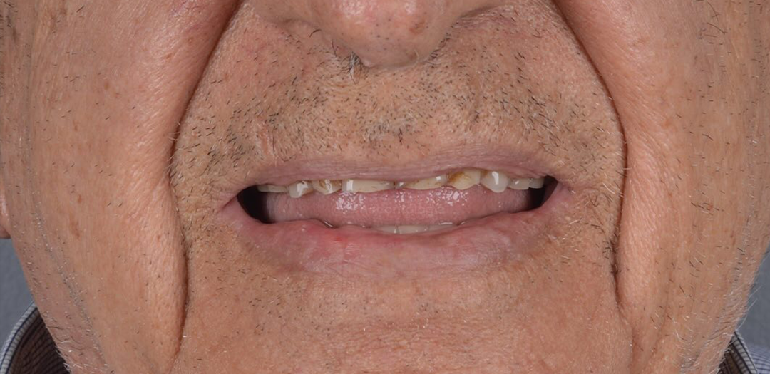 Antes do protocolo: dentes superiores muito desgastados, quebrados e escurecidos
