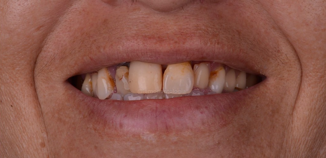 Antes do protocolo: dentes anteriores com manchas, restaurações escurecidas e desnível de gengiva