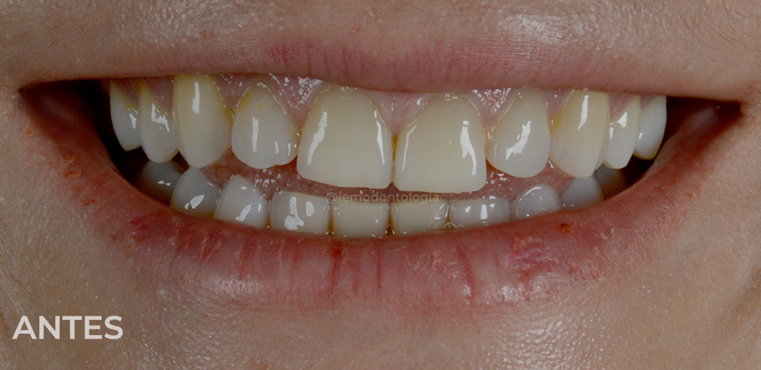 Antes das facetas: dentes amarelados com bordas irregulares e desgastadas