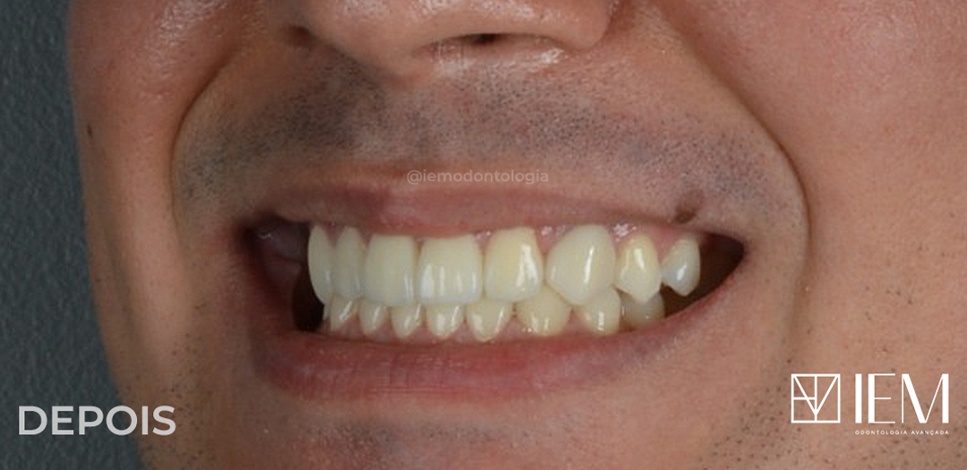 Depois das facetas: sorriso amplo com dentes alinhados, uniformes e clareados