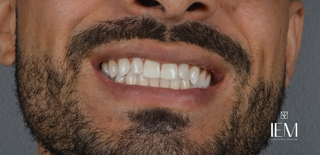 Depois do clareamento: dentes visivelmente mais brancos e brilhantes
