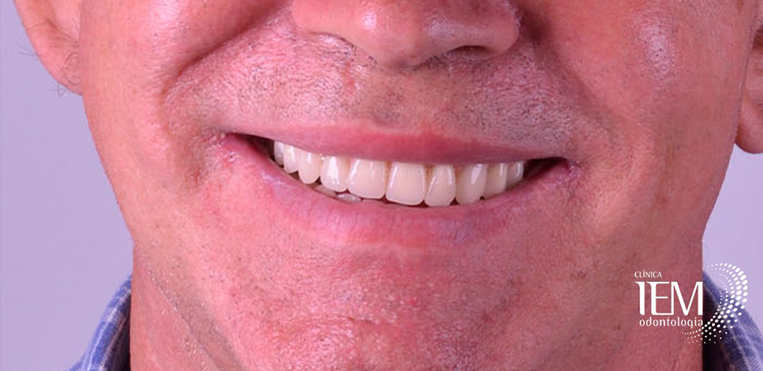 Depois do protocolo: arcada superior completa reabilitada, com dentes claros e uniformes