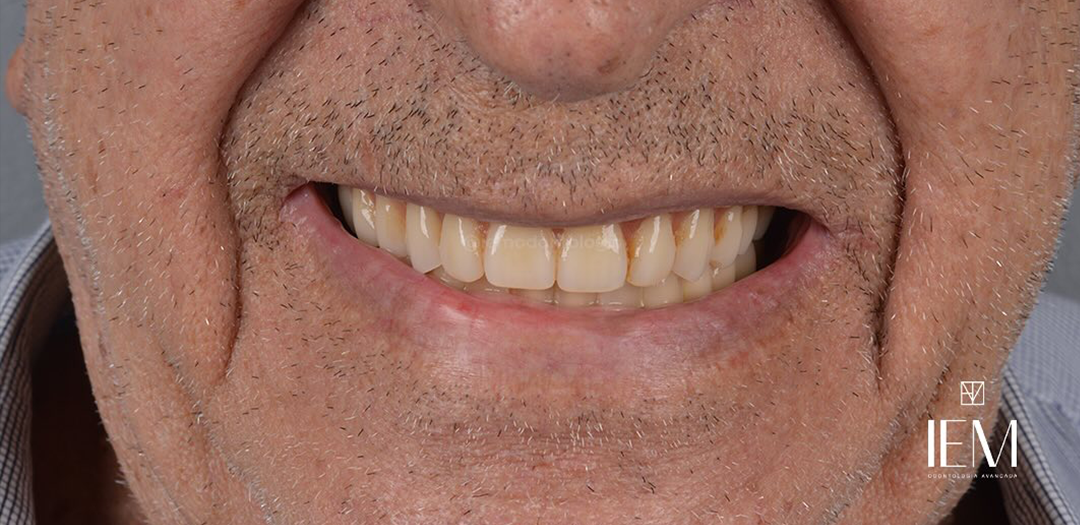 Depois do protocolo: sorriso completo reabilitado, arcadas superior e inferior íntegras