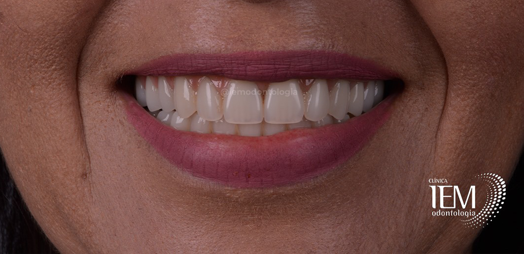 Depois do protocolo: sorriso reabilitado com dentes claros, alinhados e uniformes