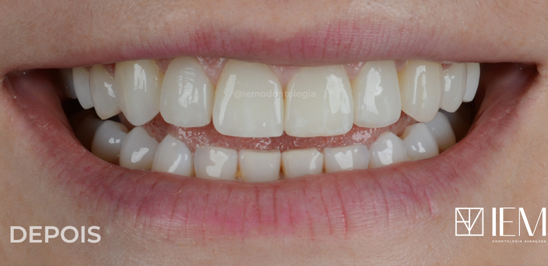 Depois das facetas: dentes claros, uniformes e com bordas regulares