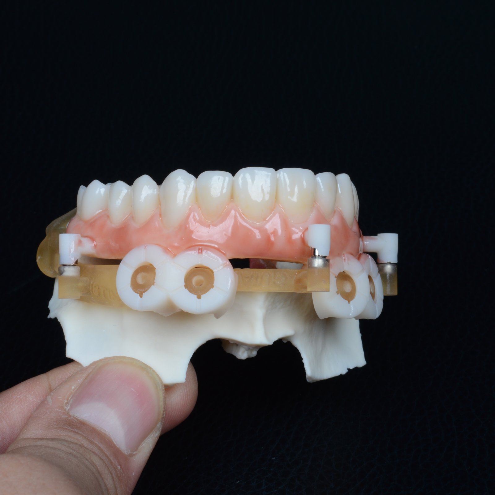 Prótese provisória de arcada completa sobre implantes, com gengiva caracterizada em resina, instalada sobre modelo de maxila impresso em 3D — vista lateral