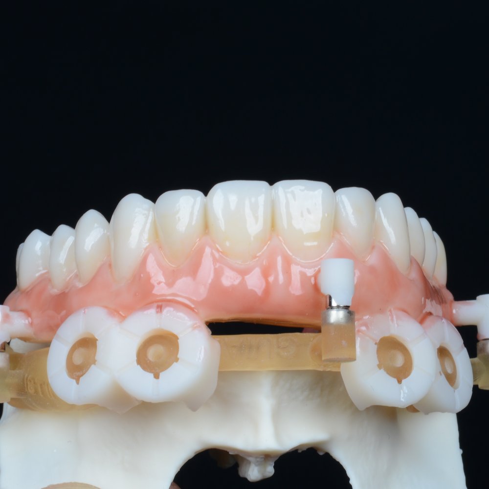 Prótese provisória de arcada completa — vista frontal do acabamento de dentes e gengiva em resina