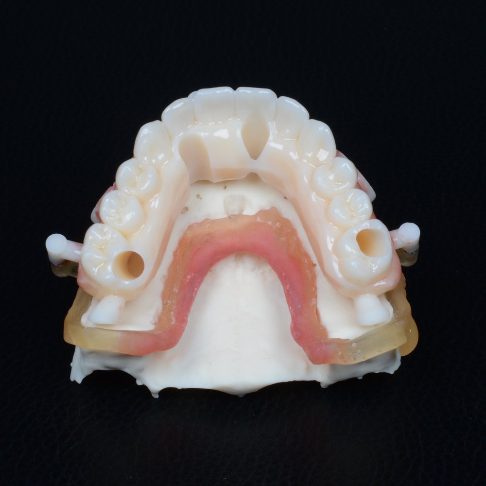 Prótese provisória superior assentada sobre modelo impresso em 3D — vista oclusal do ajuste