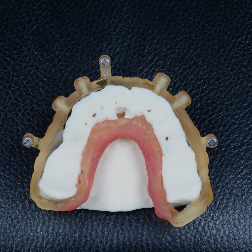 Guia cirúrgico em resina com máscara gengival sobre modelo de maxila impresso em 3D — vista oclusal