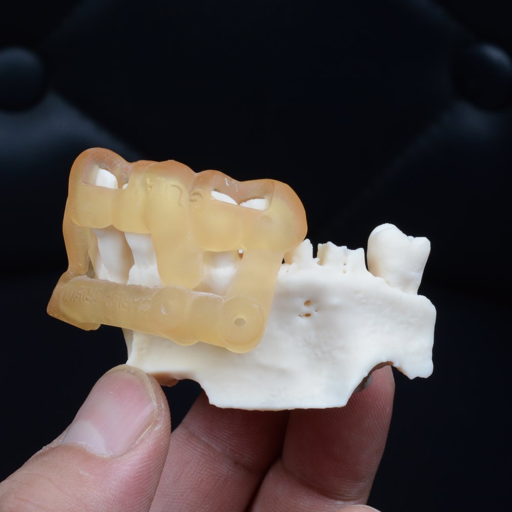 Guia cirúrgico impresso em resina assentado sobre modelo ósseo de maxila impresso em 3D